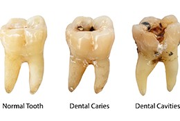 Various stages of decay needing tooth-colored fillings in Goodlettsville