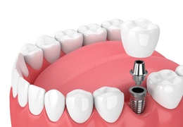 single dental implant showing the parts of the process.