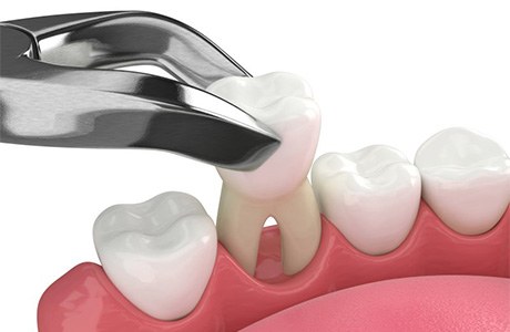 A 3D illustration of a tooth being extracted