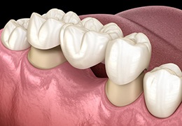 dental bridge replacing missing bottom tooth