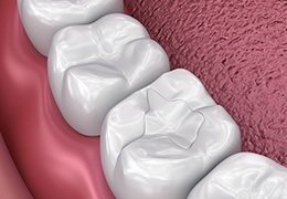 Animation of tooth-colored filling placement