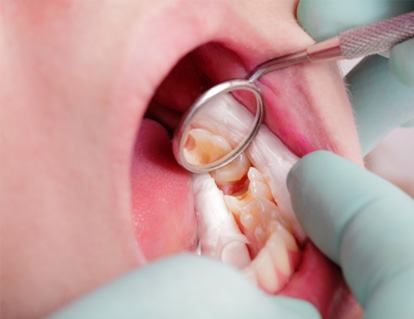 Closeup of dental mirror reflecting someone’s cavities in their lower arch