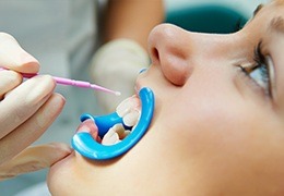 Closeup of patient receiving fluoride treatment