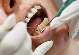 Patient receiving laser gum disease treatment