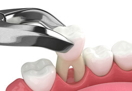 illustration of tooth being extracted