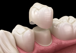 3D image of a dental crown being put on a tooth