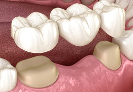 Digital image of a dental bridge being placed