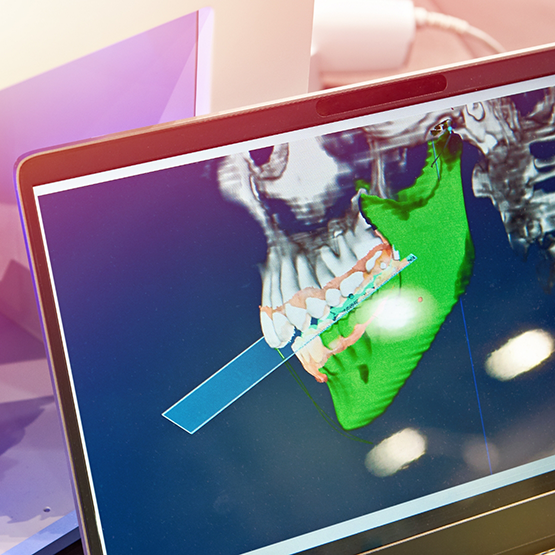 Computer screen showing a digital scan of a patient's jaws