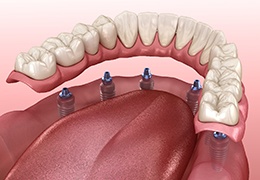 Implant dentures in Goodlettsville