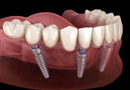 implant-retained dentures on bottom arch