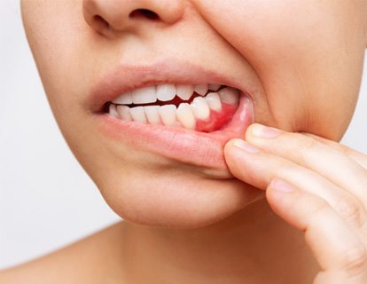 Nose-to-neck view of someone pulling down lower lip to reveal dark red gums