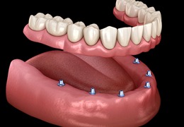 Implant dentures work in Goodlettsville