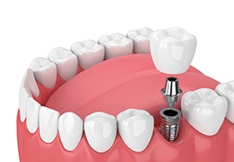 3D illustration of single dental implants