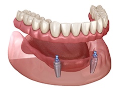 3D illustration of implant denture 