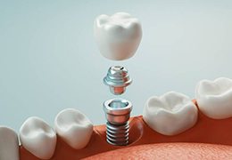 model of dental implants in Goodlettsville