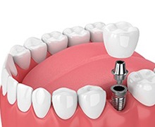 dental implant being placed in the lower jaw