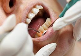 person receiving gum disease treatment in Goodlettsville