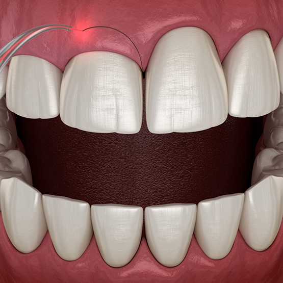 Illustration of a dental laser correcting an uneven gumline
