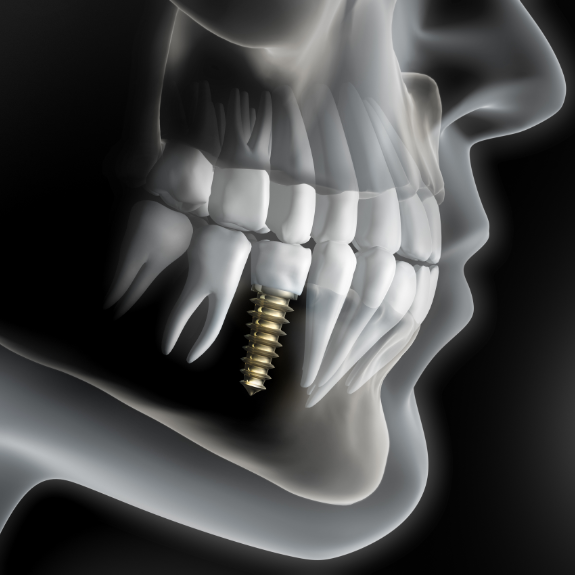 Illustration of a dental implant