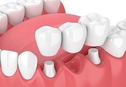 Animated dental bridge placement