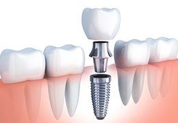 Animated dental implant supported dental crown placement