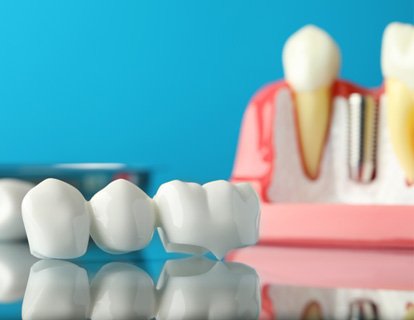 Dental bridge and implant on reflective surface with light blue background