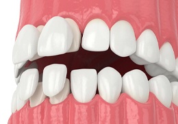 Image of porcelain veneers being placed over natural teeth