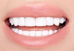 A person’s smile with porcelain veneers