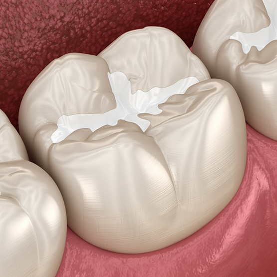 Illustration of a tooth with a dental sealant