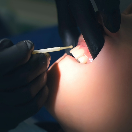 Dental patient having fluoride placed on their teeth