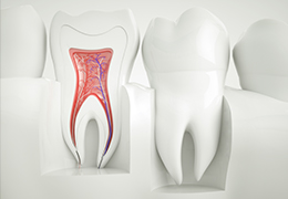 Model of the inside of the tooth before root canal therapy