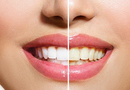 Before and after of teeth whitening