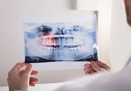 X-ray showing need for wisdom tooth extraction in Goodlettsville