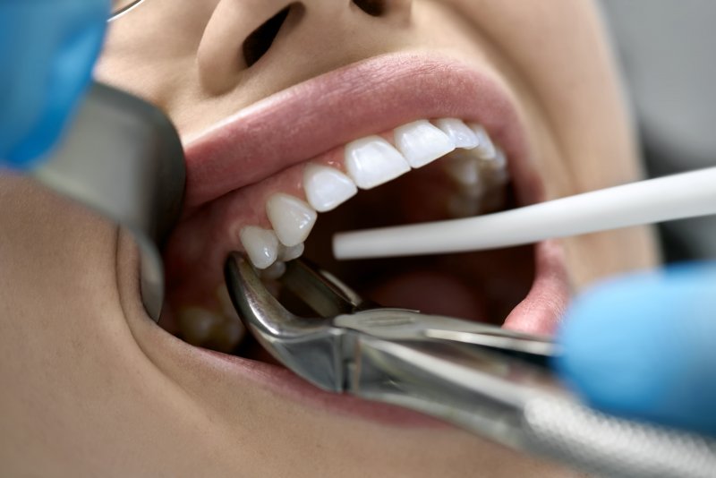 A closeup of a woman receiving tooth extraction