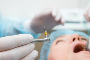 Dentist holding a dental implant